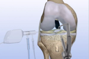 Torn ACL Anatomic Footprint Reconstruction