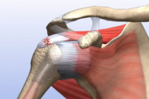 Fully Torn Rotator Cuff