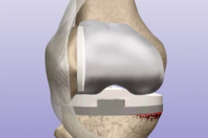 Revision Total Knee Replacement